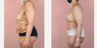 Case 2276 - 45-54 year old woman treated with Tummy Tuck