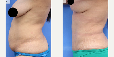 Case 2277 - Woman treated with Tummy Tuck