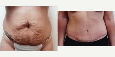Case 2278 - 25-34 year old woman treated with Tummy Tuck