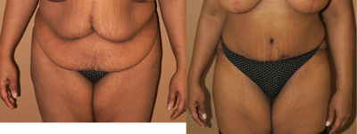 Case 2281 - 35-44 year old woman treated with Tummy Tuck