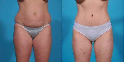 Case 2284 - 25-34 year old woman treated with Tummy Tuck