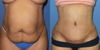 Case 2285 - 35 year old woman who had a tummy tuck and liposuction