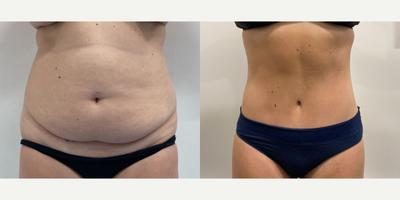 Case 229 - 35-44 year old woman treated with Tummy Tuck