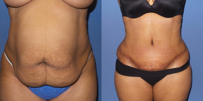 Case 2291 - 35 year old 6 weeks after tummy tuck and lipo flanks