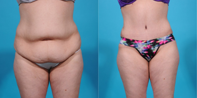 Case 2293 - 25-34 year old woman treated with Bikini Incision Tummy Tuck and Liposuction