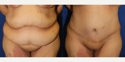 Case 23 - 35-44 year old woman treated with Tummy Tuck