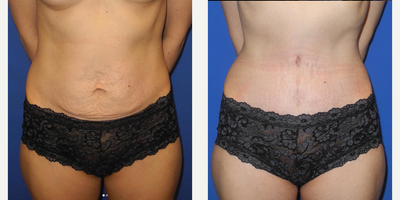 Case 230 - 35-44 year old woman treated with Tummy Tuck