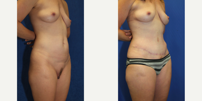 Case 2305 - 43 year old woman treated with Tummy Tuck