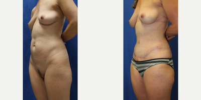 Case 2306 - 43 year old woman treated with Tummy Tuck