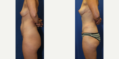Case 2307 - 43 year old woman treated with Tummy Tuck