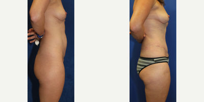 Case 2308 - 43 year old woman treated with Tummy Tuck