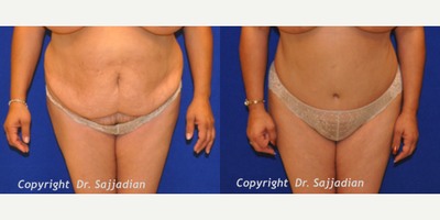 Case 2309 - Tummy Tuck