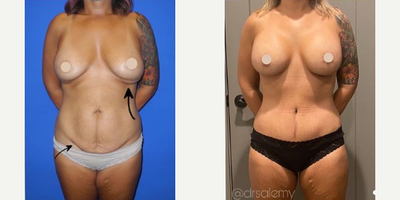 Case 231 - Woman treated with Breast Implants, Tummy Tuck