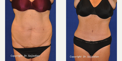 Case 2310 - Tummy Tuck