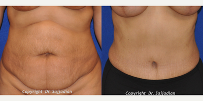 Case 2311 - Tummy Tuck