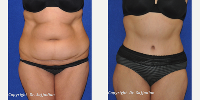 Case 2312 - Tummy Tuck