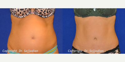 Case 2313 - Tummy Tuck
