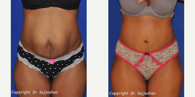 Case 2314 - Tummy Tuck