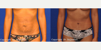 Case 2315 - Tummy Tuck
