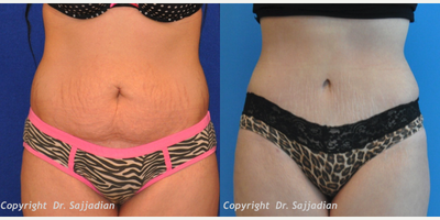 Case 2316 - Tummy Tuck