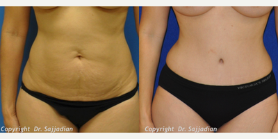 Case 2317 - Tummy Tuck