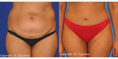Case 2318 - Tummy Tuck
