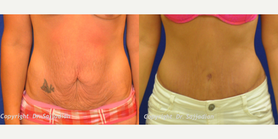 Case 2319 - Tummy Tuck