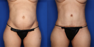Case 232 - 35-44 year old woman treated with Tummy Tuck