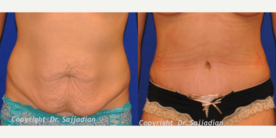 Case 2320 - Tummy Tuck