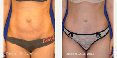 Case 2321 - Tummy Tuck