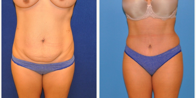 Case 2322 - Tummy Tuck