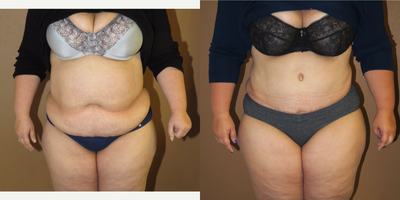 Case 2323 - 45-54 year old woman treated with Tummy Tuck