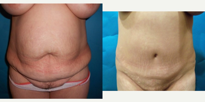 Case 2324 - 35-44 year old woman treated with Tummy Tuck
