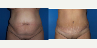 Case 2325 - 35-44 year old woman treated with Tummy Tuck