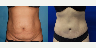 Case 2326 - 25-34 year old woman treated with Tummy Tuck