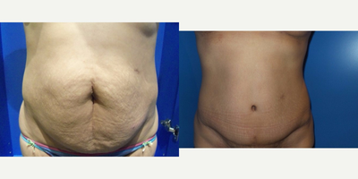 Case 2327 - 45-54 year old woman treated with Tummy Tuck