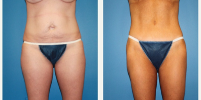 Case 2328 - 35-44 year old woman treated with Tummy Tuck