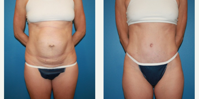 Case 2329 - 35-44 year old woman treated with Tummy Tuck