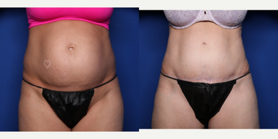 Case 233 - 35-44 year old woman treated with Tummy Tuck