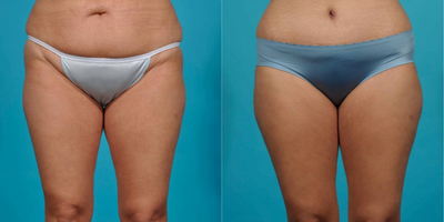 Case 2330 - 35-44 year old woman treated with Tummy Tuck