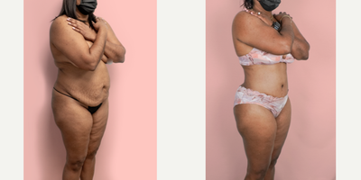 Case 2339 - 45-54 year old woman treated with Tummy Tuck