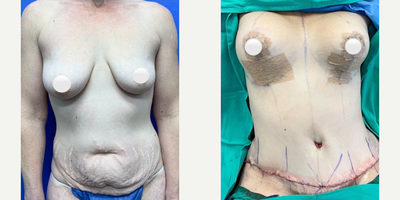 Case 234 - Woman treated with Tummy Tuck, Breast Lift