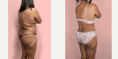 Case 2340 - 45-54 year old woman treated with Tummy Tuck