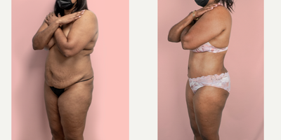 Case 2341 - 45-54 year old woman treated with Tummy Tuck