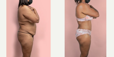 Case 2342 - 45-54 year old woman treated with Tummy Tuck