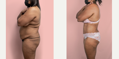 Case 2343 - 45-54 year old woman treated with Tummy Tuck