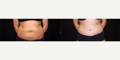 Case 2344 - Tummy Tuck - Abdominoplasty