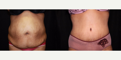 Case 2345 - Tummy Tuck - Abdominoplasty