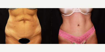 Case 2346 - Tummy Tuck - Abdominoplasty