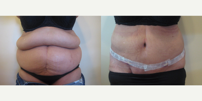 Case 2347 - Tummy Tuck - Abdominoplasty